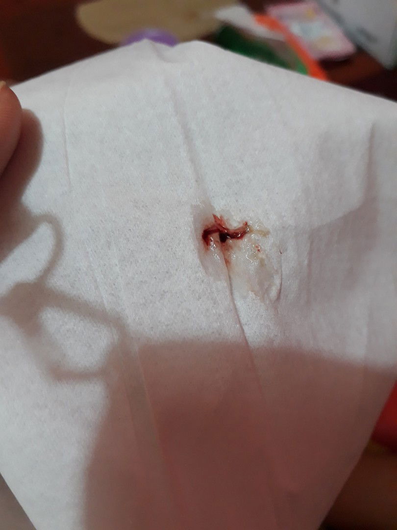 lendir darah di hidung