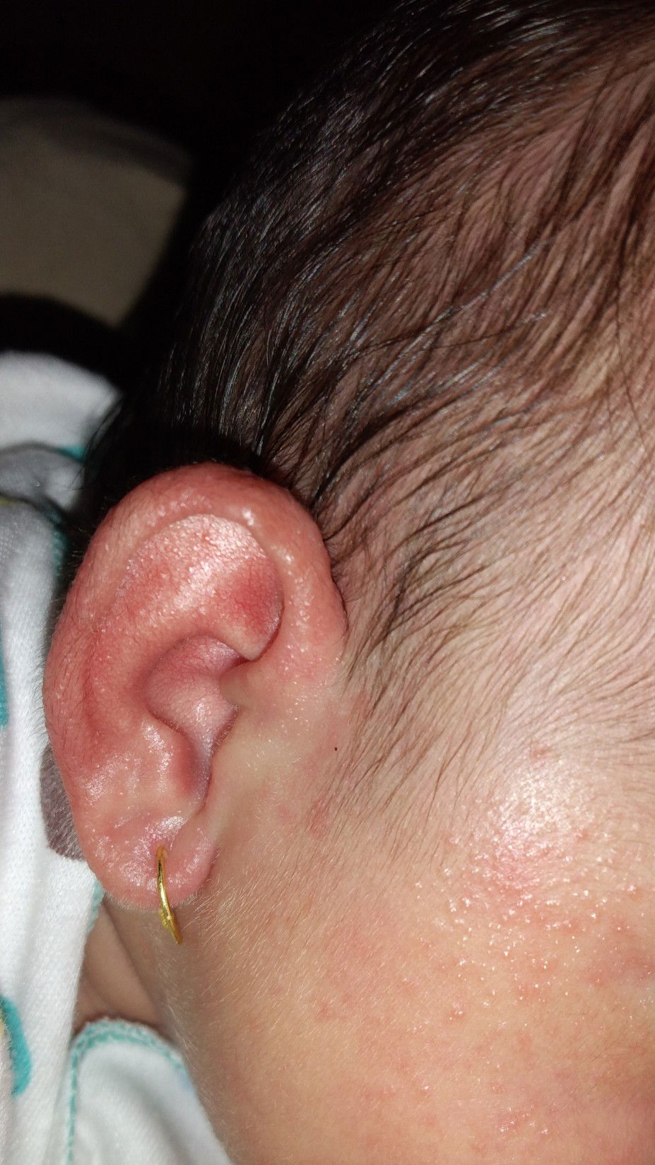 Ruam di wajah dan di bokong bayi.