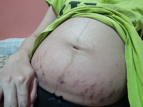 35 Weeks Preg Stretch Mark Problem