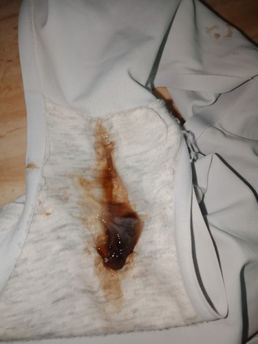 mucus plug