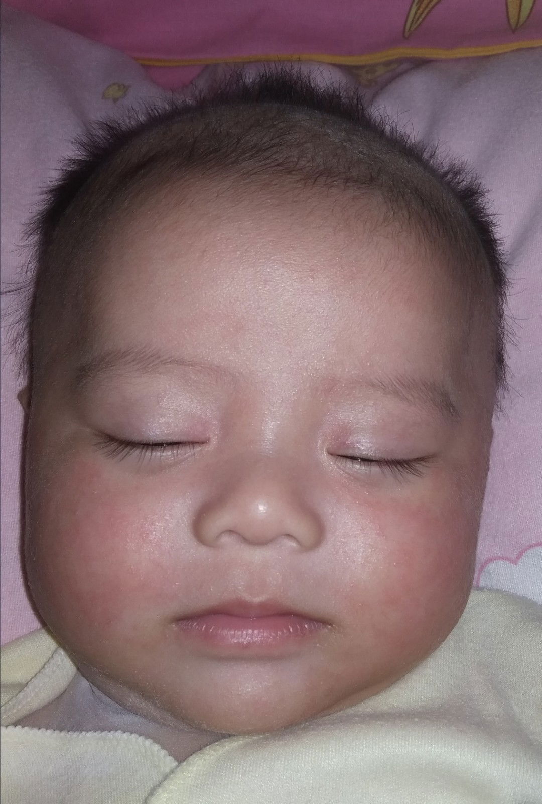 Bun Bantu Solusi Ya.. Pipi Merah2 Dan Kasar..