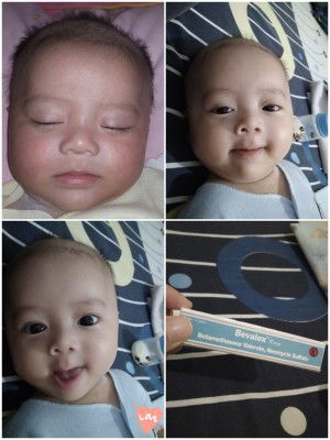 Maaf Bukan Pertanyaan, Memberikan Solusi Dari Pipi Merah Pada Bayi Saya Kmaren