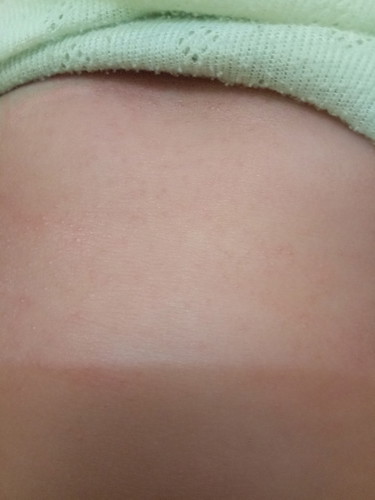 biang keringat atau alergi?