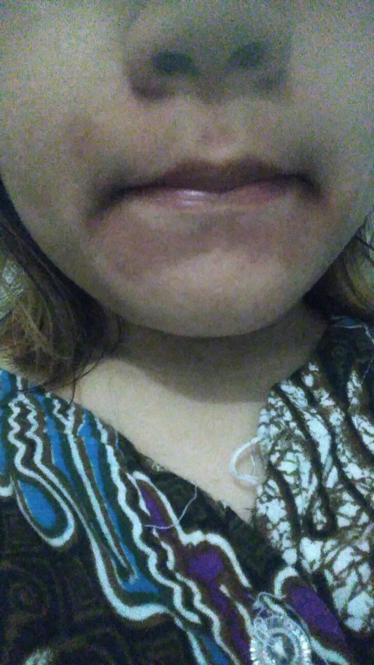 cara menghilangkan bekas eczema