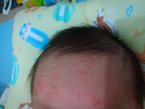 alergi pada bayi baru lahir