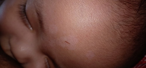 White spots or marks at the Forehead