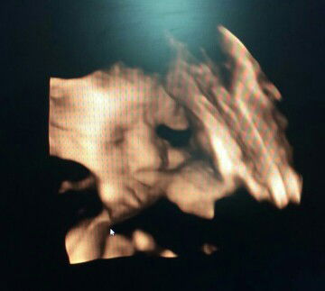 Ada lilitan tali pusar di leher, masih bisakah normal?