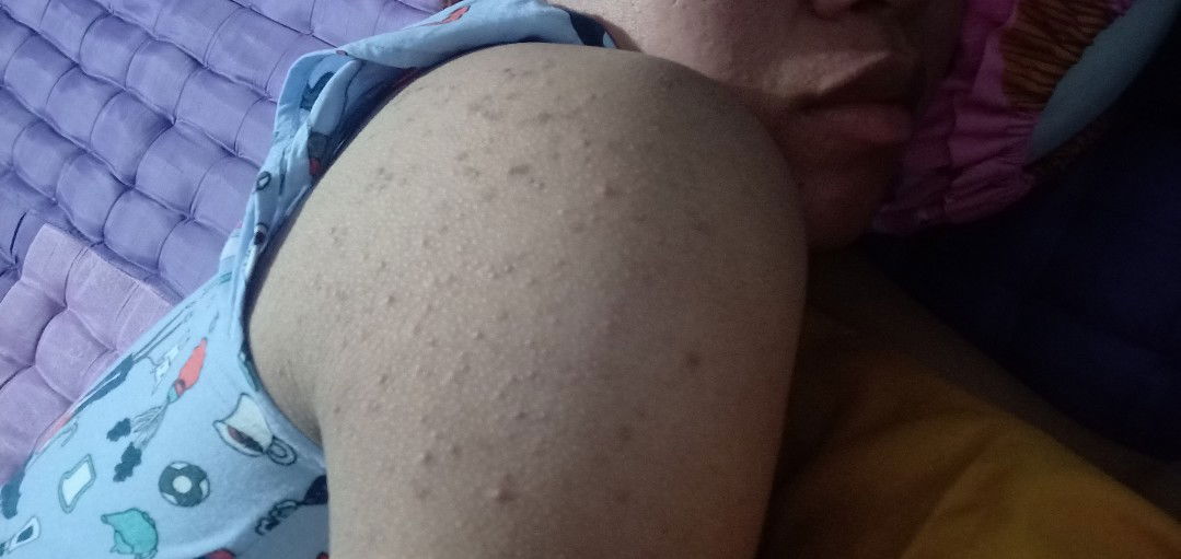 jrawat dipundak/lengan