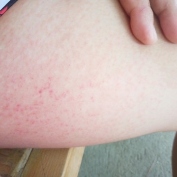 rash???