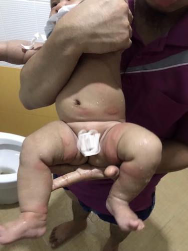 ลูกเป็นผื่น