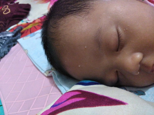Jerawat Baby