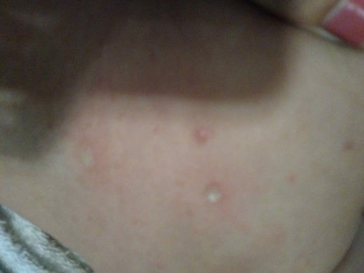 apakah ini cacar air atau ruam karna tak cocok susu formula,  apa bunda pernah mengalami hal ini pada bayi anda?