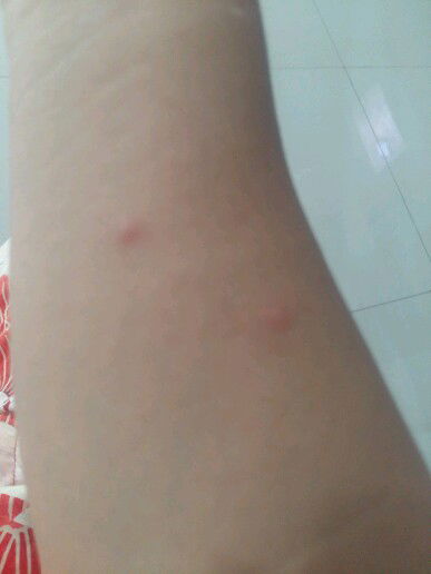 Bentol Gigitan Nyamuk