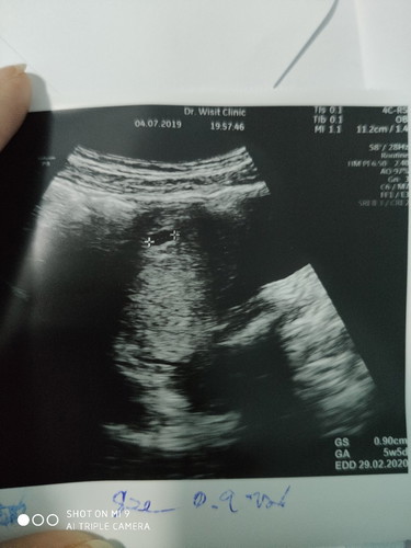 เสี่ยงท้องลม