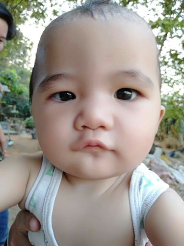 ตาโตข้างเดียว มีใครเปนบ้าง