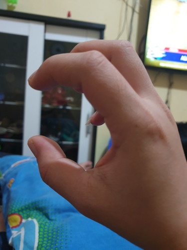 saya lagi hamil 32 week mom.. kaki tangan bengkak .. tapi sulit di getakan .. ga bisa genggam tangan .. kalo jalan kaki sakit ... ada yg gitu juga mom ?
