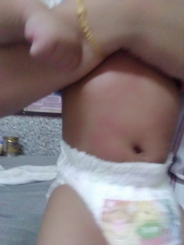 ผื่นแดง หัวขาวๆ