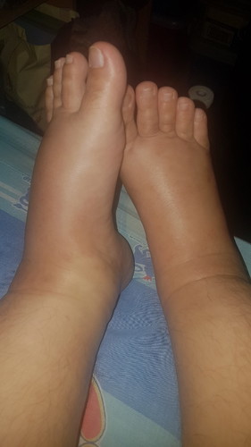 kaki bengkak