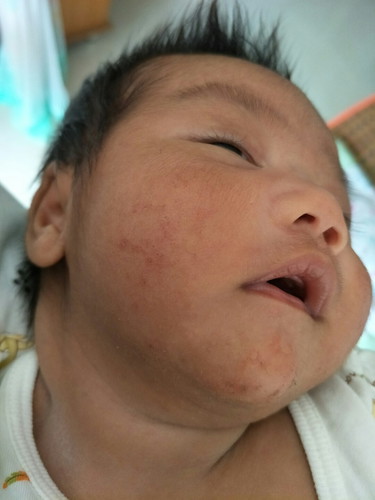 ผื่นแดง