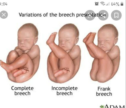 frank breech presentation