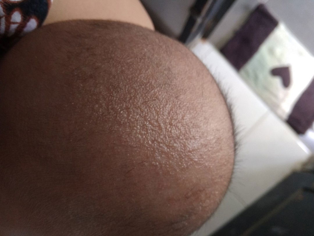 gatal-gatal d kepala