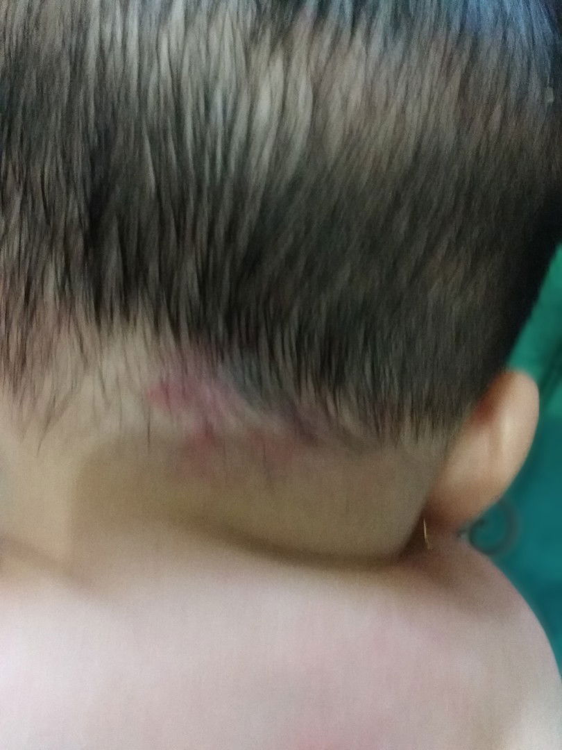 tanda merah di tekuk leher