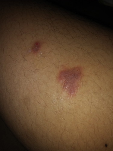 ruam dan gatal saat hamil