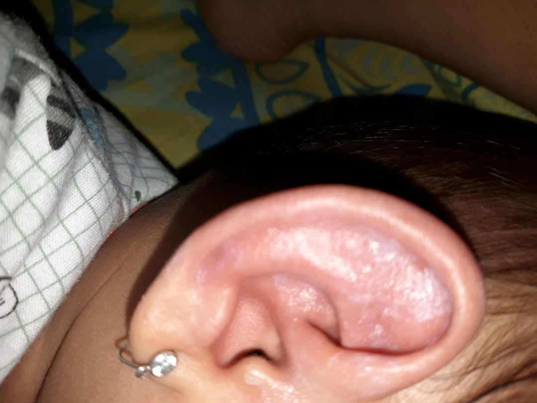 habis bersihin telinga pakai baby oil kok jadi gatal