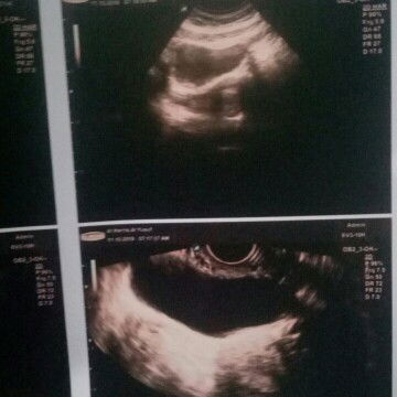 hasil usg keguguran