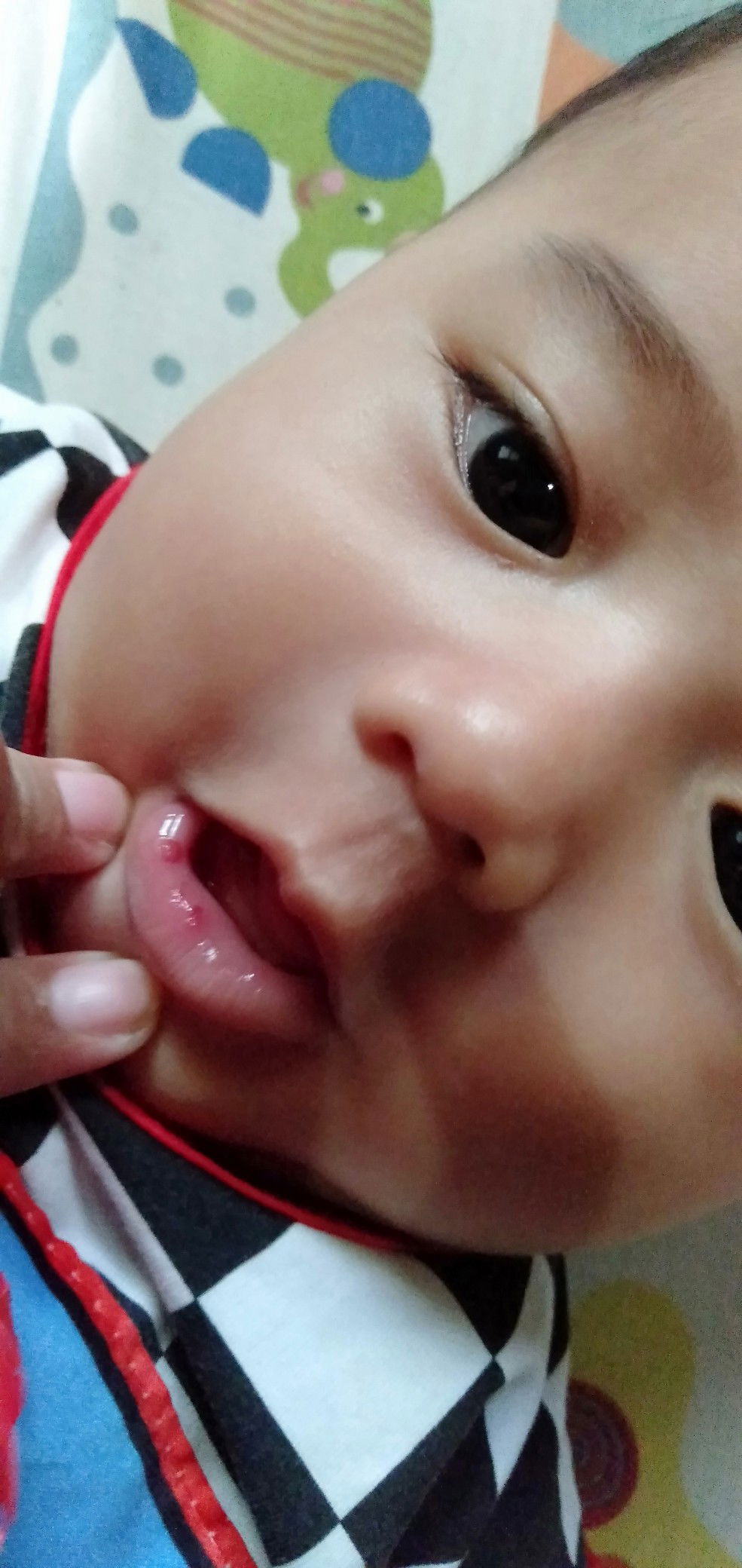 Merah pada bibir bayi