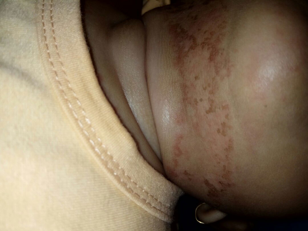 kulit merah dan kering jadi gosong serta melebar