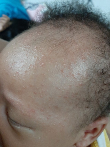 rashes