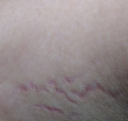 STRETCH MARK