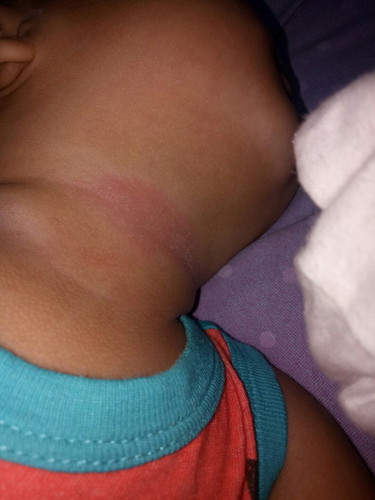 RASHES!