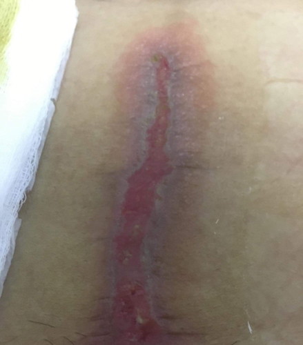 CS Wound
