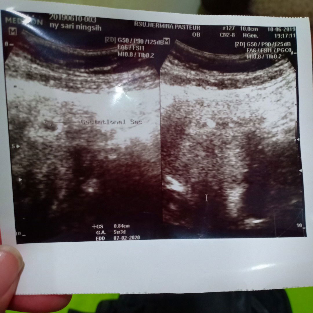 sore bun..mau tanya beberapa hari yg lalu saya ke dokter bilang klu usia kandungan saya 5minggu tapi janin belm keliatan sya jdi.deg2an surh dateng lagi 2minggu an lagi..ada yg pengalamam seperti saya .saya takut klu ga ada..