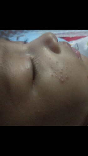 Bintik pada pipi bayi