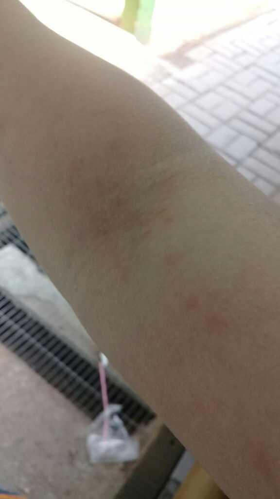 bintik bintik merah saat menyusui