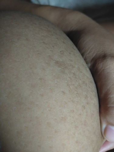STRETCH MARKS