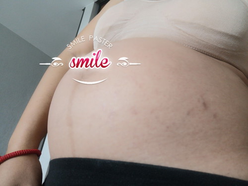 ท้องแตกลาย