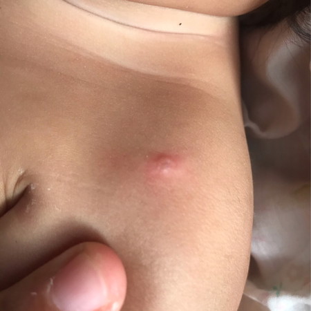 น้องอยู่ๆฝีก็แดงขึ้นมา