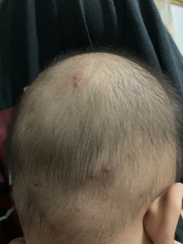 สอบถามค่ะ ศีระษะเป็นสิวหนอง