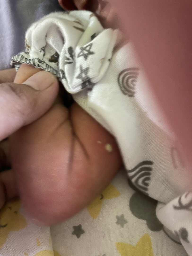 Bentol bernanah pada bayi newborn