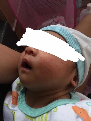 Rashes??