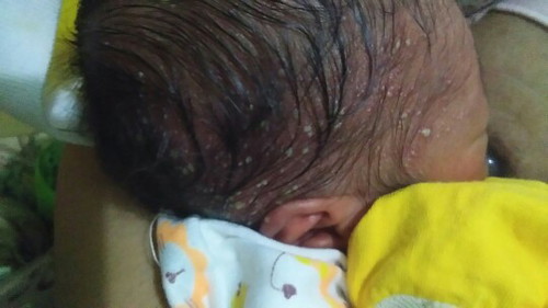 Bintik Nanah dan Bau dikepala