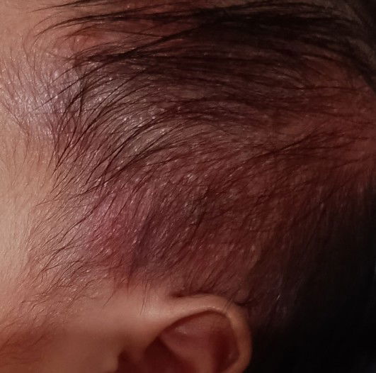 Biang keringat newborn