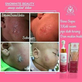masalah kulit baby menjadi2?