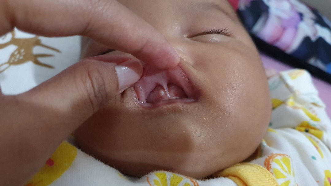 Bayi 2,5 bulan tumbuh gigi