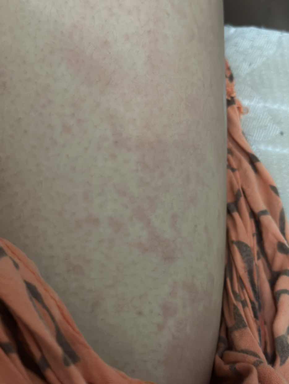 Gatal setelah melahirkan