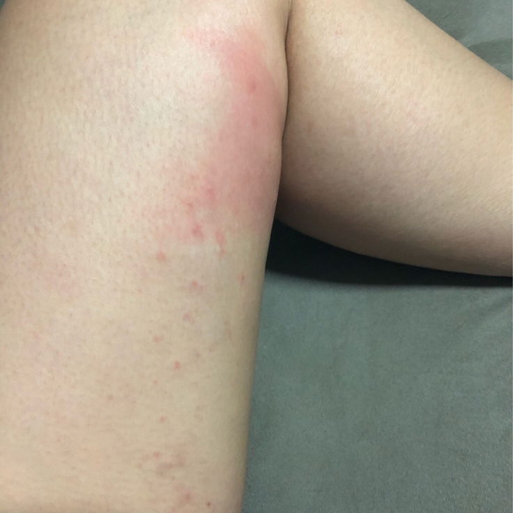 ผื่นคัน ตอนท้องจะหายตอนไหนค่ะ ทรมานมากๆเลยค่ะ คันสุดๆ